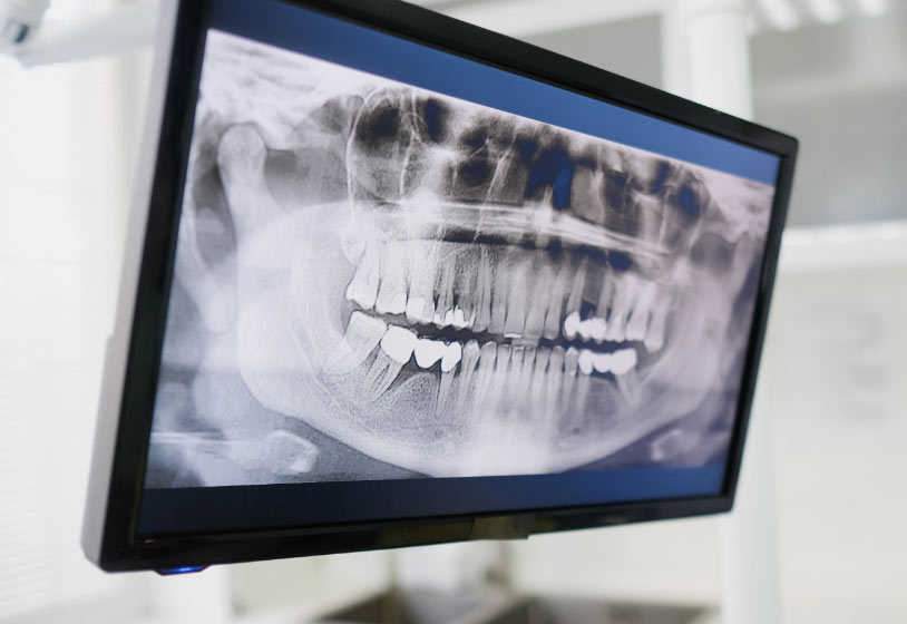 monitor showing a dental x-ray from a patient at Oregon Wisdom Teeth in Salem, OR